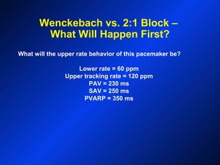 Wenckebach vs. 2:1 Block –
What Will Happen First?
What will the upper rate behavior of this pacemaker be?
Lower rate = 60 ppm
Upper tracking rate = 120 ppm
PAV = 230 ms
SAV = 250 ms
PVARP = 350 ms
 