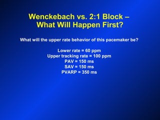 Wenckebach vs. 2:1 Block –
What Will Happen First?
What will the upper rate behavior of this pacemaker be?
Lower rate = 60 ppm
Upper tracking rate = 100 ppm
PAV = 150 ms
SAV = 150 ms
PVARP = 350 ms
 