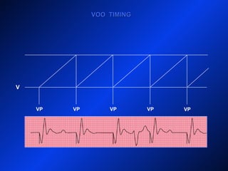 V
VP VPVP
VOO TIMINGVOO TIMING
VP VP
 