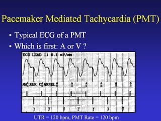 UTR = 120 bpm, PMT Rate = 120 bpm
 