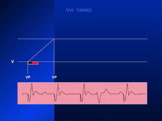 VP VP
VS
VPVP
VVI TIMINGVVI TIMING
V
 