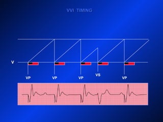 V
VP VPVP VP
VS
VVI TIMINGVVI TIMING
 