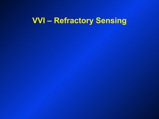 VVI – Refractory Sensing
 