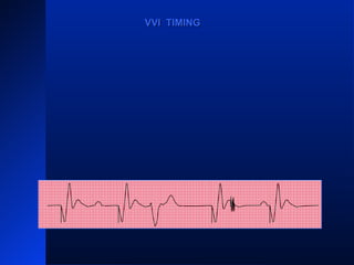 VPVP VPVP
VVI TIMINGVVI TIMING
 