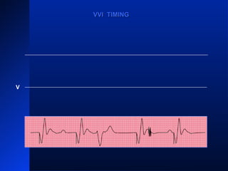 VPVP VPVP
V
VVI TIMINGVVI TIMING
 