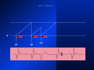 VP VP
VS
VP
V
VVI TIMINGVVI TIMING
 