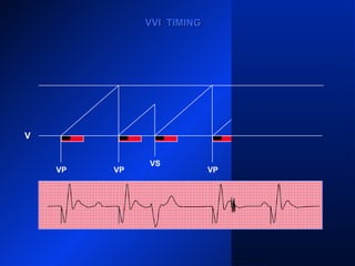 VP VP
VS
VP VP
V
VVI TIMINGVVI TIMING
 