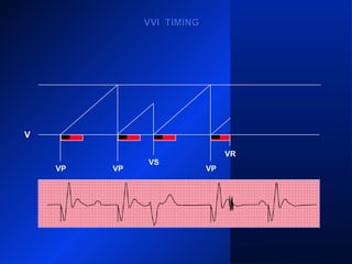 VP VP
VS
VP VP
V
VR
VVI TIMINGVVI TIMING
 