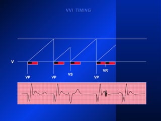 VP VP
VS
VP VP
VR
V
VVI TIMINGVVI TIMING
 