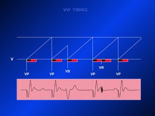V
VVI TIMINGVVI TIMING
VP VP
VS
VP VP
VR
 