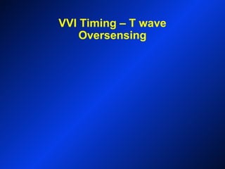 VVI Timing – T wave
Oversensing
 
