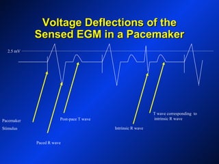 Voltage Deflections of theVoltage Deflections of the
Sensed EGM in a PacemakerSensed EGM in a Pacemaker
Pacemaker
Stimulus
Paced R wave
Post-pace T wave
Intrinsic R wave
T wave corresponding to
intrinsic R wave
2.5 mV
 