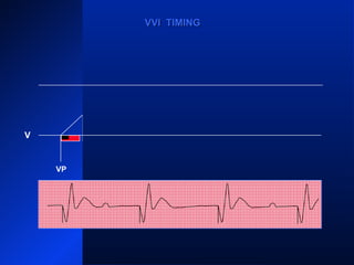 VP VP
VS
VPVP
VVI TIMINGVVI TIMING
V
 