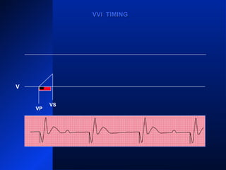 VP VP
VS
VPVP
VS
VVI TIMINGVVI TIMING
V
 