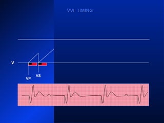 VP
VS
VP
VS
VPVP
VVI TIMINGVVI TIMING
V
 