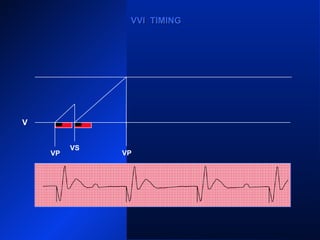 VP
VS
VP
VS
VP
VVI TIMINGVVI TIMING
V
VP
 