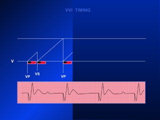 VP VP
VS
VP
VS
VP
VVI TIMINGVVI TIMING
V
 