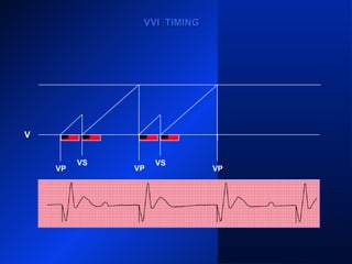 VP VP
VS VS
VP
VS
VVI TIMINGVVI TIMING
V
VP
 