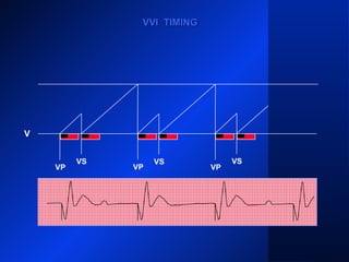 VP VP
VS
VP
VS
VP
VS
VVI TIMINGVVI TIMING
V
 