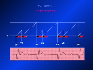 V
VVI TIMINGVVI TIMING
VP VP
VS
VP
VS
VP
VS
T wave re-cycling
 