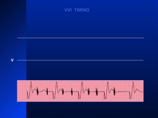 VP
VR VR VRVR VR
VPVP
VVI TIMINGVVI TIMING
V
 