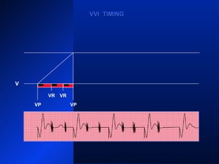 VP VP
VRVR VR VRVR VR
VPVP
VVI TIMINGVVI TIMING
V
VP
VR
 