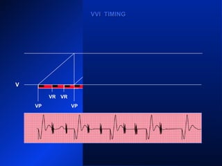 VP VP VP
VRVR VR VRVR VR
VPVP
VVI TIMINGVVI TIMING
V
VR
 