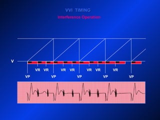 V
VP VPVP
VVI TIMINGVVI TIMING
VP VP
VRVR VR VRVR VR
Interference Operation
VR
 