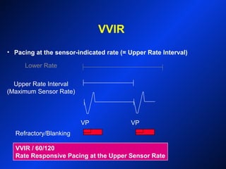 VVIR
VP VP
Refractory/Blanking
Lower Rate
Upper Rate Interval
(Maximum Sensor Rate)
VVIR / 60/120
Rate Responsive Pacing at the Upper Sensor Rate
• Pacing at the sensor-indicated rate (= Upper Rate Interval)
 