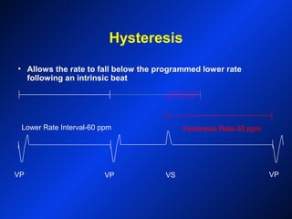 VP VP VS VP
Lower Rate Interval-60 ppm
Hysteresis
• Allows the rate to fall below the programmed lower rate
following an intrinsic beat
Hysteresis Rate-50 ppm
 