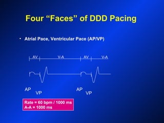 Rate = 60 bpm / 1000 ms
A-A = 1000 ms
AP
VP
AP
VP
V-AAV V-AAV
• Atrial Pace, Ventricular Pace (AP/VP)
Four “Faces” of DDD Pacing
 