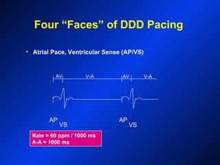 Rate = 60 ppm / 1000 ms
A-A = 1000 ms
AP
VS
AP
VS
V-AAV V-AAV
• Atrial Pace, Ventricular Sense (AP/VS)
Four “Faces” of DDD Pacing
 