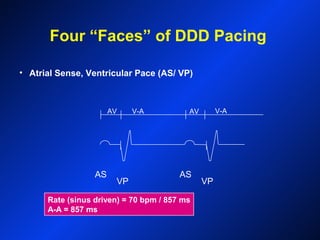 AS
VP
AS
VP
Rate (sinus driven) = 70 bpm / 857 ms
A-A = 857 ms
• Atrial Sense, Ventricular Pace (AS/ VP)
V-AAV AV V-A
Four “Faces” of DDD Pacing
 