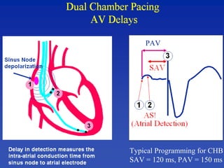 PAV
Typical Programming for CHB
SAV = 120 ms, PAV = 150 ms
 