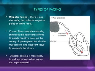 TYPES OF PACING
• Unipolar Pacing - There is one
electrode, the cathode (negative
pole) or active lead.
• Current flows from the cathode,
stimulates the heart and returns
to anode (positive pole) on the
casing of pulse generator via the
myocardium and adjacent tissue
to complete the circuit.
• Unipolar sensing is more likely
to pick up extracardiac signals
and myopotentials.
 