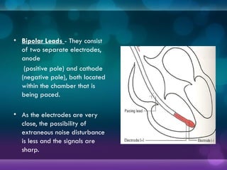 • Bipolar Leads - They consist
of two separate electrodes,
anode
(positive pole) and cathode
(negative pole), both located
within the chamber that is
being paced.
• As the electrodes are very
close, the possibility of
extraneous noise disturbance
is less and the signals are
sharp.
 