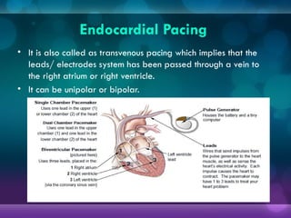 Endocardial Pacing
• It is also called as transvenous pacing which implies that the
leads/ electrodes system has been passed through a vein to
the right atrium or right ventricle.
• It can be unipolar or bipolar.
 