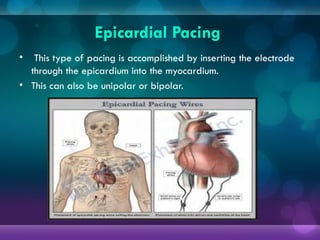 Epicardial Pacing
• This type of pacing is accomplished by inserting the electrode
through the epicardium into the myocardium.
• This can also be unipolar or bipolar.
 