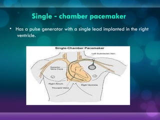 Single chamber pacemaker
‑
• Has a pulse generator with a single lead implanted in the right
ventricle.
 