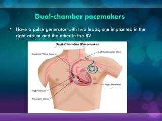 Dual chamber pacemakers
‑
• Have a pulse generator with two leads, one implanted in the
right atrium and the other in the RV
 
