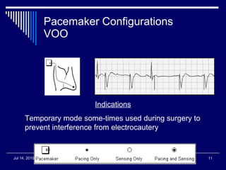 Pacemaker Configurations VOO Indications Temporary mode some-times used during surgery to prevent interference from electrocautery 