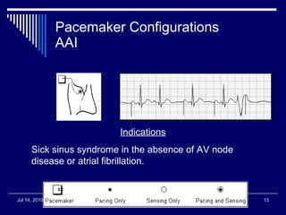 Pacemaker Configurations AAI Indications Sick sinus syndrome in the absence of AV node disease or atrial fibrillation.  