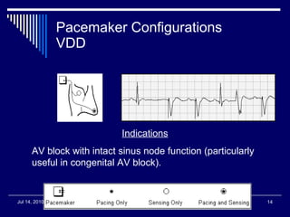 Pacemaker Configurations VDD Indications AV block with intact sinus node function (particularly useful in congenital AV block).  