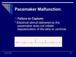 Pacemaker Malfunction . Failure to Capture: * Electrical stimuli delivered by the pacemaker does not initiate depolarization of the atria or ventricle  