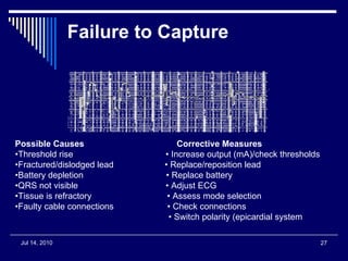Failure to Capture   Possible Causes  Corrective Measures • Threshold rise  • Increase output (mA)/check thresholds • Fractured/dislodged lead  • Replace/reposition lead • Battery depletion  • Replace battery • QRS not visible  • Adjust ECG • Tissue is refractory  • Assess mode selection • Faulty cable connections  • Check connections •  Switch polarity (epicardial system 