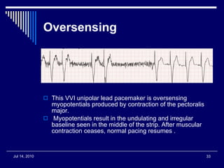 Oversensing This VVI unipolar lead pacemaker is oversensing myopotentials produced by contraction of the pectoralis major. Myopotentials result in the undulating and irregular baseline seen in the middle of the strip. After muscular contraction ceases, normal pacing resumes . 