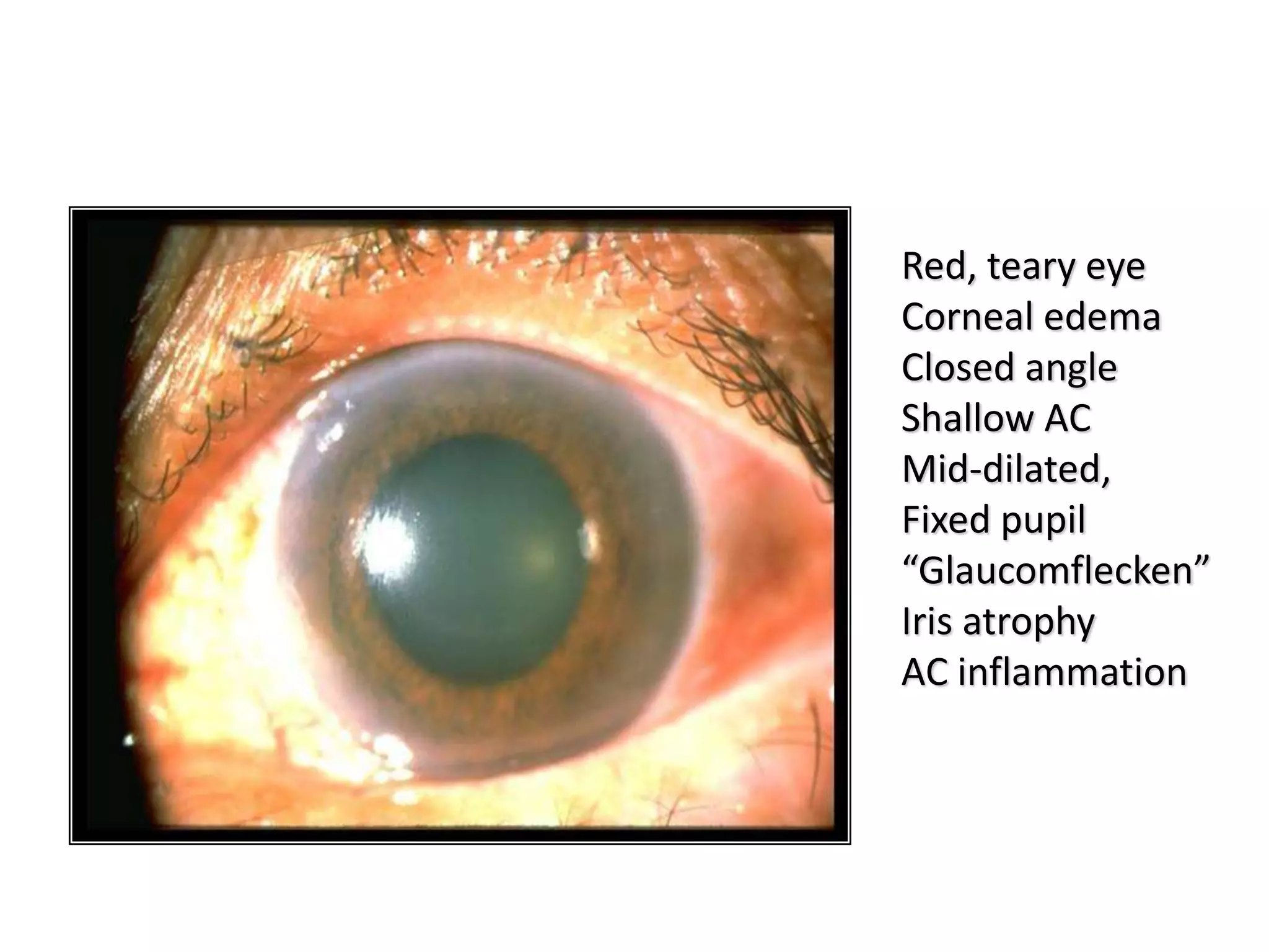 Red, teary eye
Corneal edema
Closed angle
Shallow AC
Mid-dilated,
Fixed pupil
“Glaucomflecken”
Iris atrophy
AC inflammation
 
