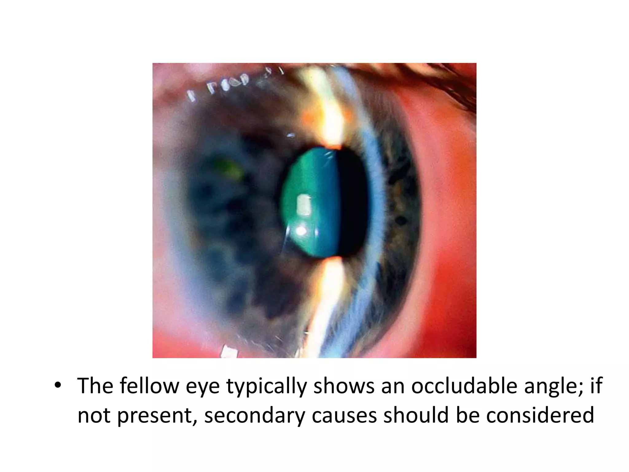 • The fellow eye typically shows an occludable angle; if
not present, secondary causes should be considered
 