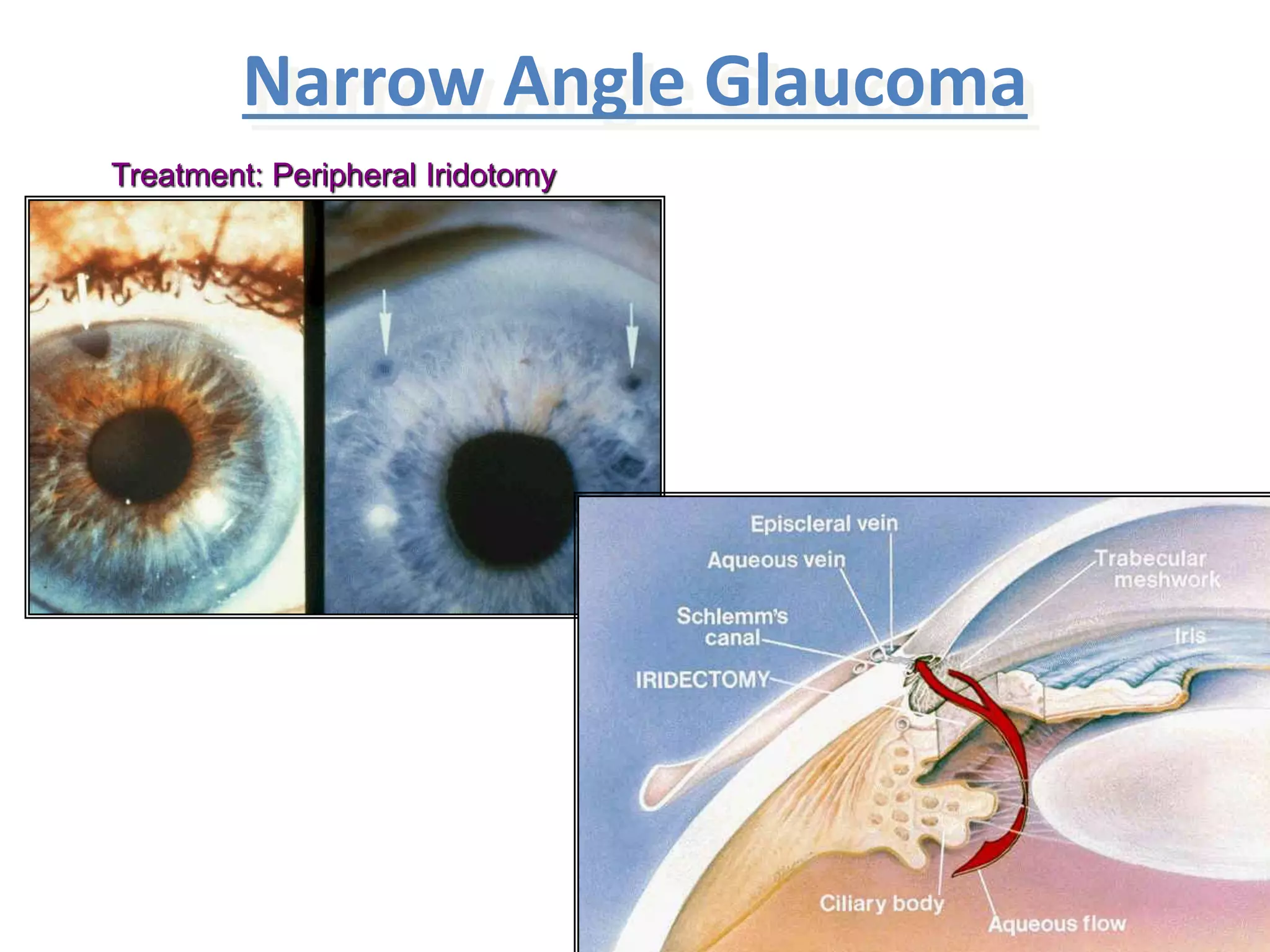Narrow Angle Glaucoma
Treatment: Peripheral Iridotomy
 