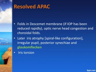 Resolved APAC
• Folds in Descemet membrane (if IOP has been
reduced rapidly), optic nerve head congestion and
choroidal folds.
• Later iris atrophy [spiral-like configuration],
irregular pupil, posterior synechiae and
glaukomflecken
• Iris torsion
 